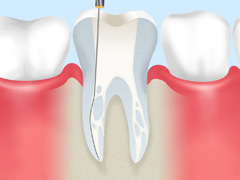 重度の虫歯は根から治療が必要です