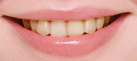 「歯の黄ばみ」のお悩みを解消する～ホワイトニング～