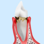 軽度の歯周病（歯肉炎）　症状