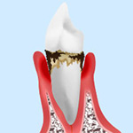 中等度の歯周病　症状